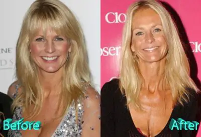 Ulrika Jonsson Boobs Before and After