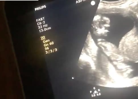 Rachel Campos Duffy's Sonogram Photo