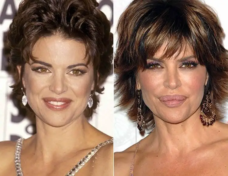 Lisa Rinna before and after surgery